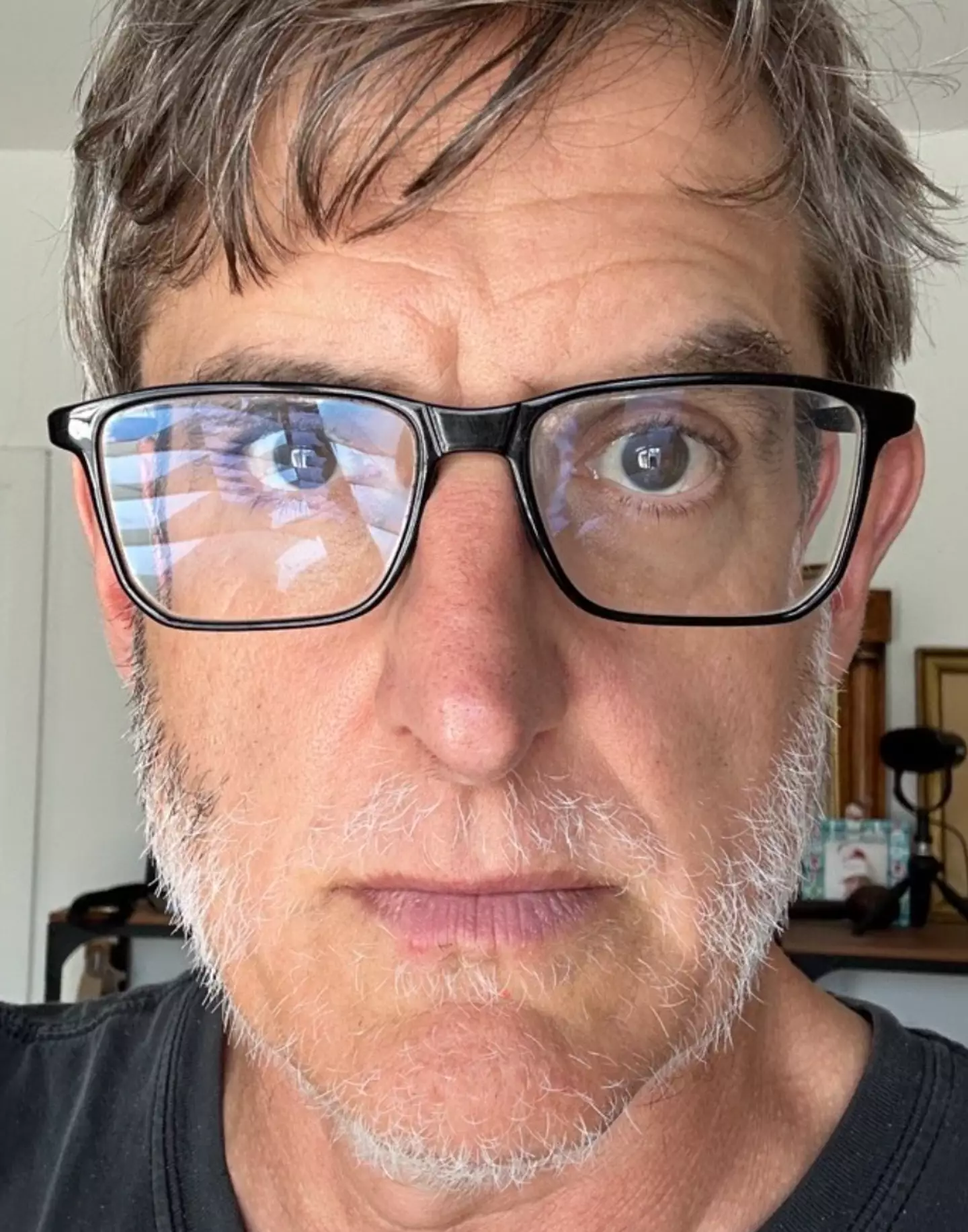 Louis Theroux has given regular updates about his alopecia.