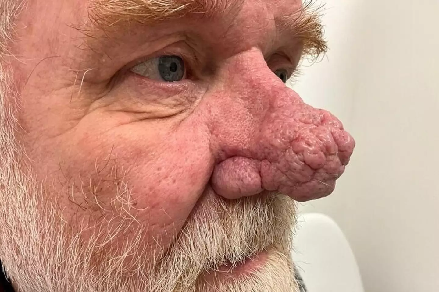 Ian suffered from a condition which caused his nose to swell up and keep growing.