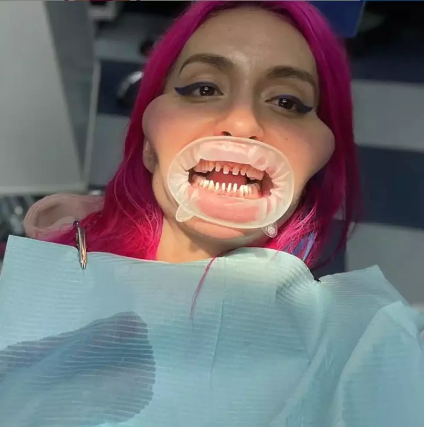 The influencer previously showed off what her teeth look like under the veneers.