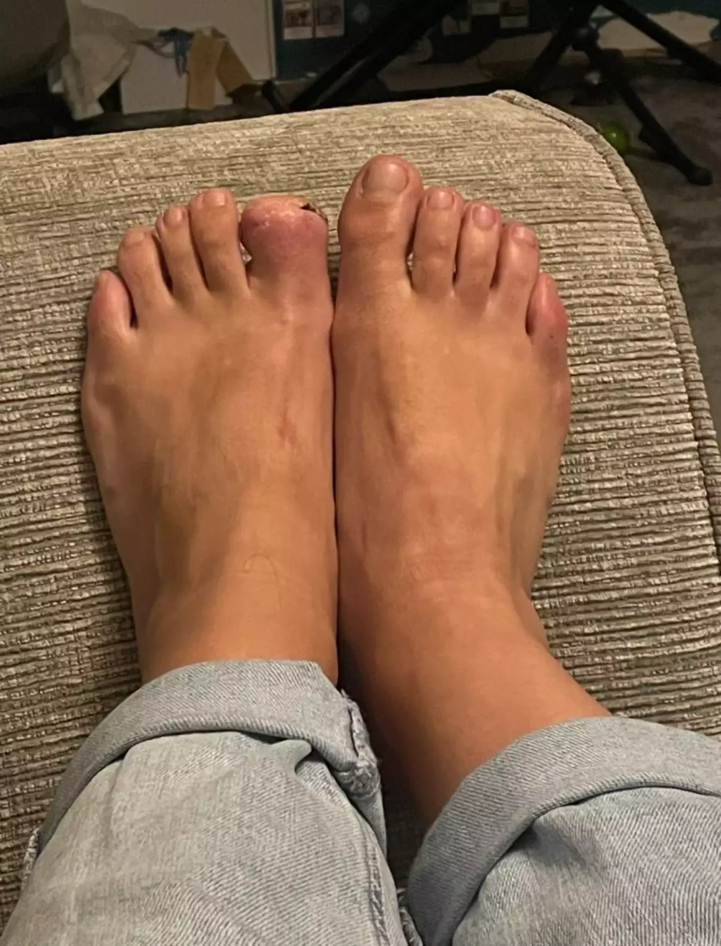 The cancer is gone now, and she's had her toe amputated as part of her surgery (Cover Images)