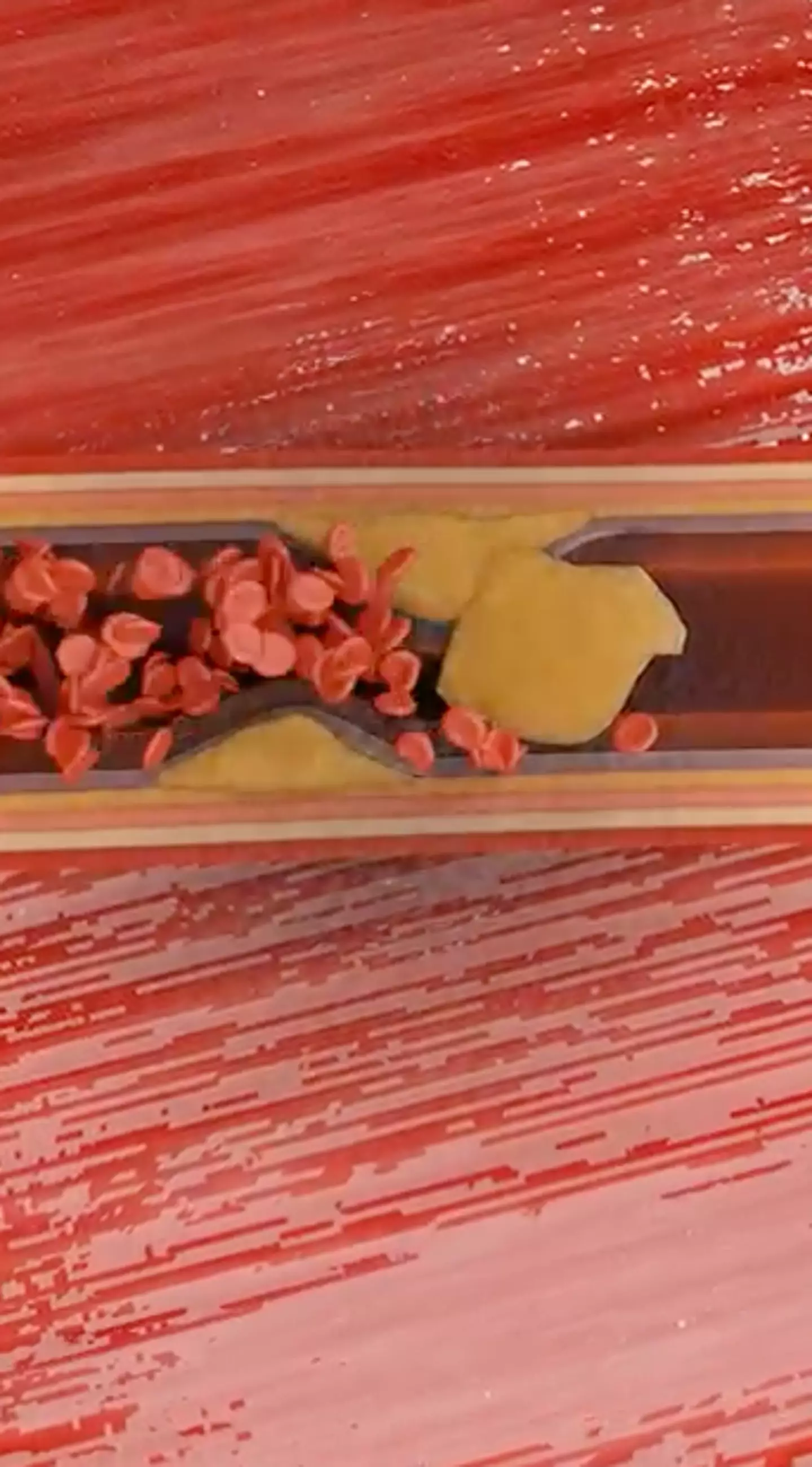 Heart attacks can happen if your arteries are blocked and your heart isn't getting enough oxygen (YouTube/The Body Doc)