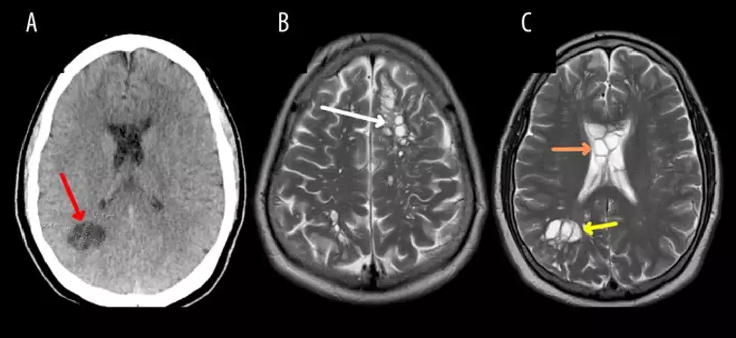 Doctors found tapeworm larval cysts were in his brain.