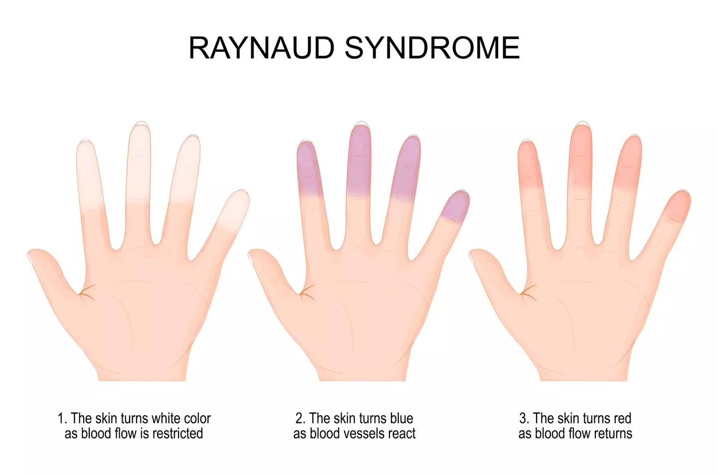 How symptoms of Raynaud's can present (Getty Stock Images)