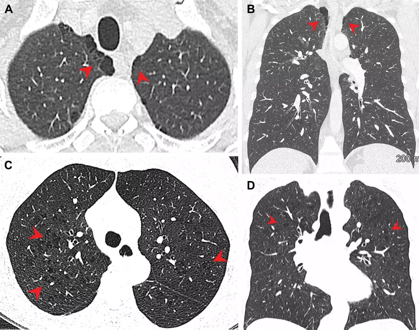 Pulmonary emphysema in marijuana smokers (A, B) and tobacco smokers (C, D).