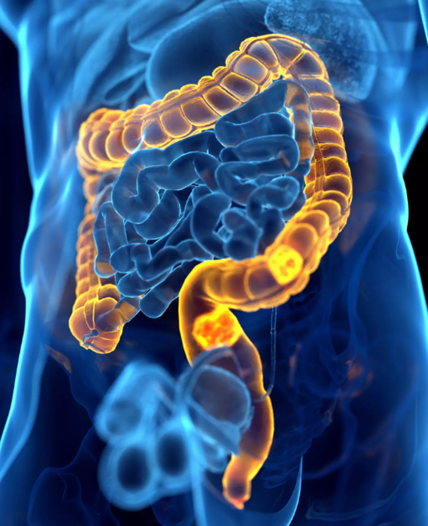 Colon cancer cases are increasing worldwide (Getty Stock Image)