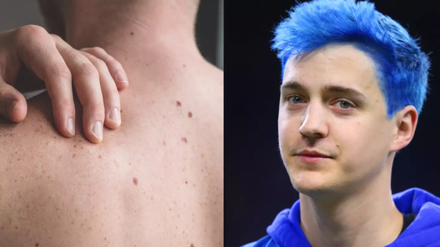 Signs to check moles for possible skin cancer following YouTuber Ninja's diagnosis