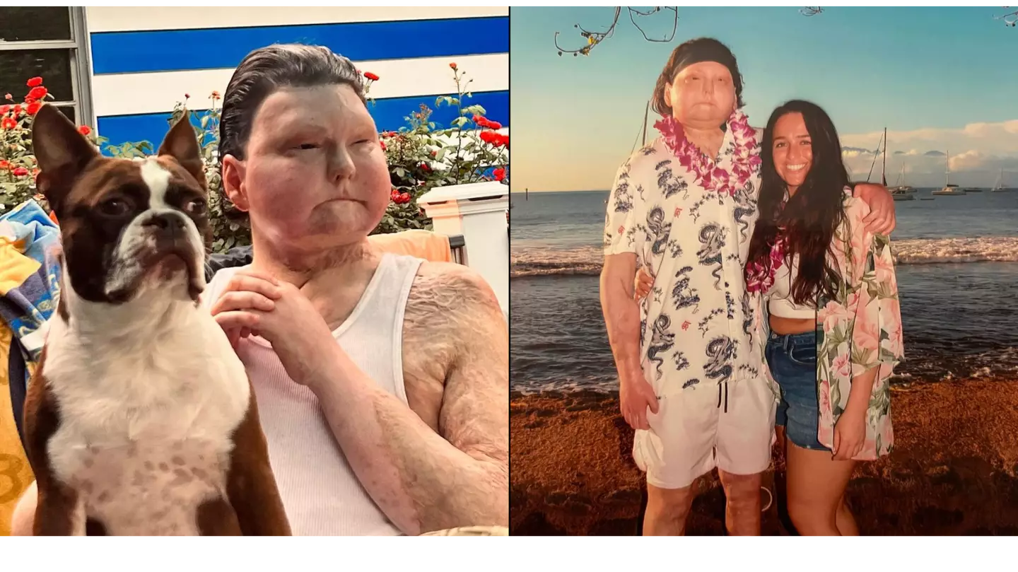 Girlfriend of man who had 'world's first face transplant' cruelly gets called 'gold digger'