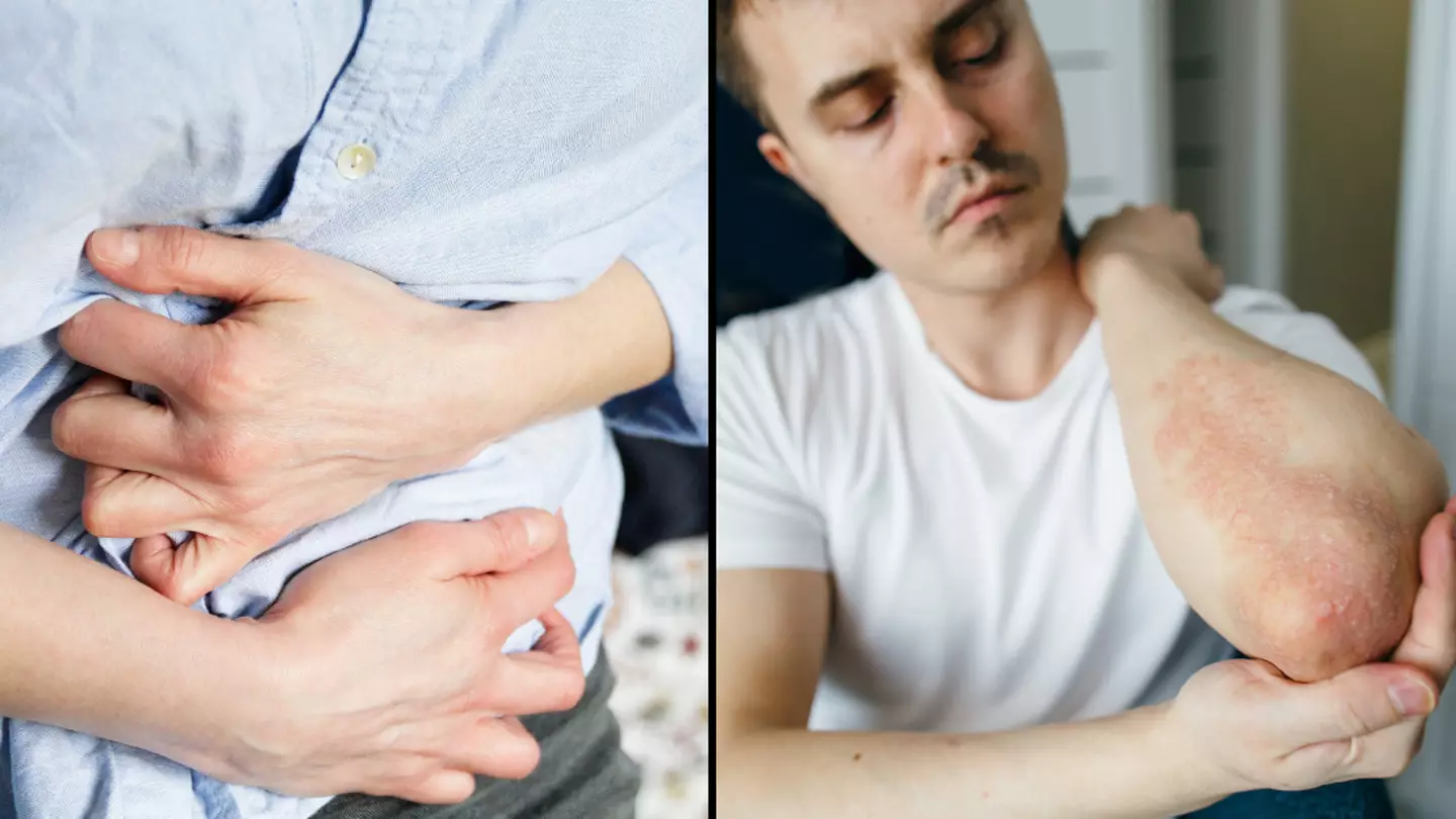 Symptoms of ‘invisible disease’ that half a million Brits suffer as cases linked to scaly skin condition