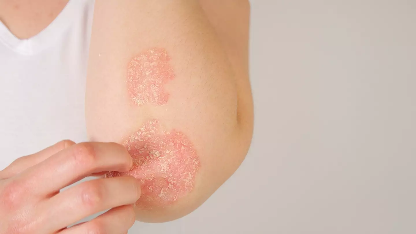 A total of 125 million people in the world are thought to have psoriasis (Getty Stock Images)