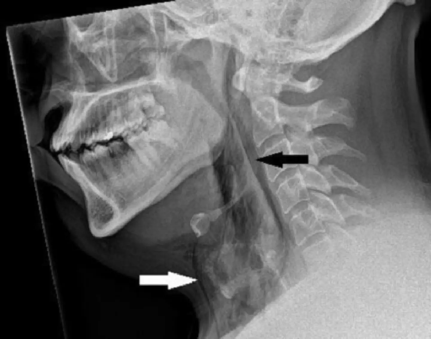 A patient in his thirties tore a hole in his throat after holding in a sneeze for too long.