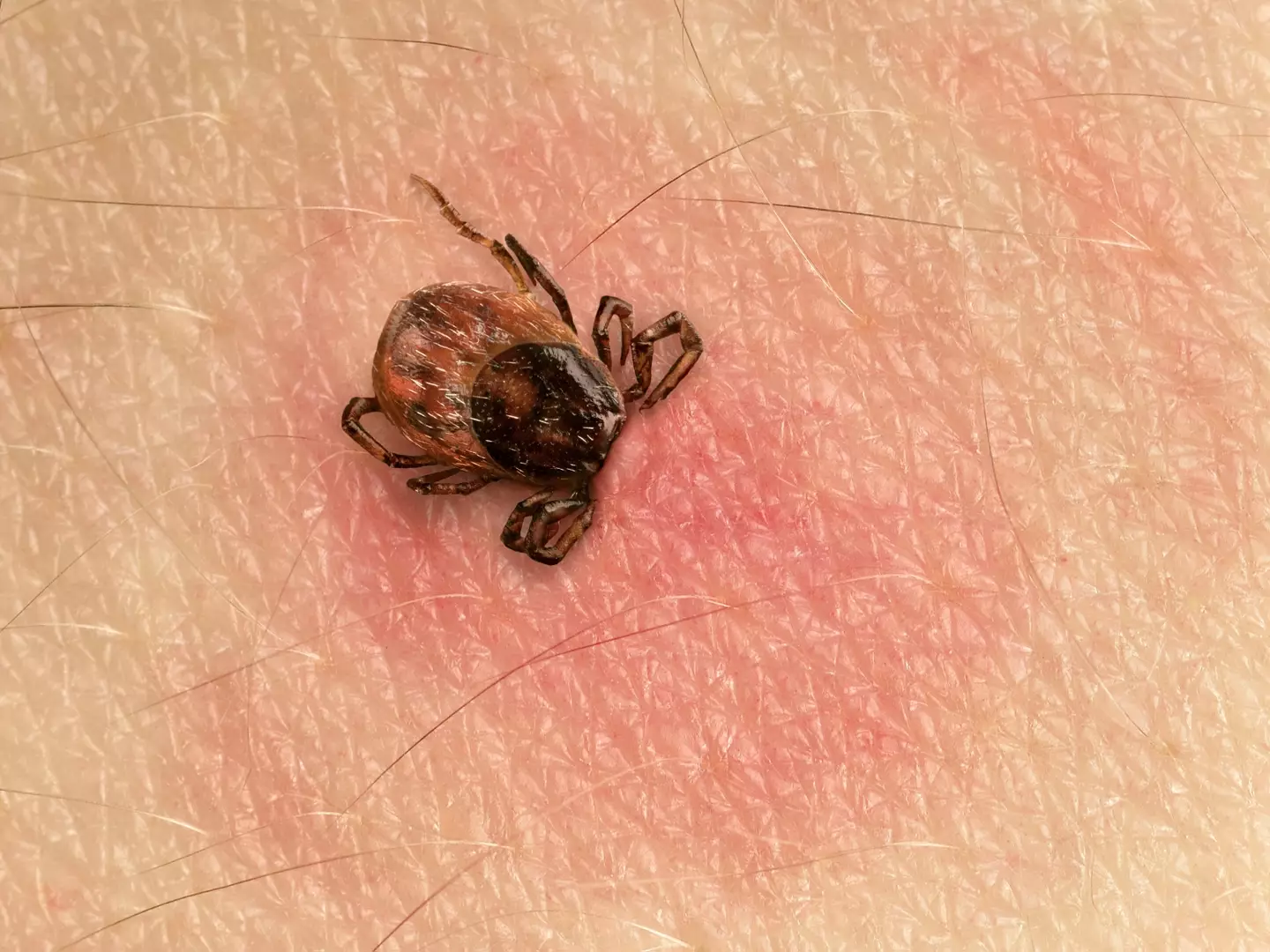 It is suspected that tick bites he suffered as a two-year-old may have given him a mammalian meat allergy (Getty Stock Image)