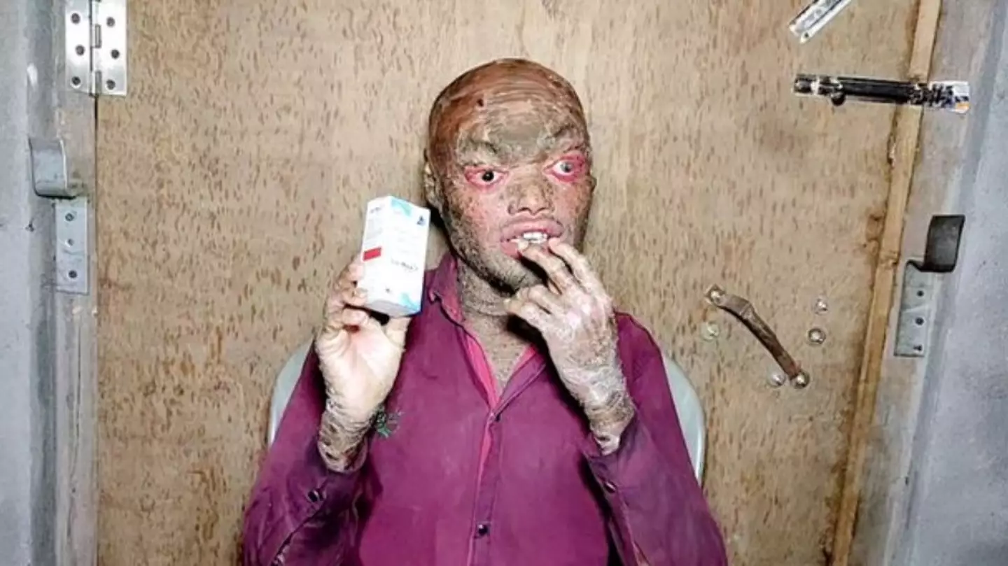 Majibar Rehman Malik, 25, suffers from erythroderma.