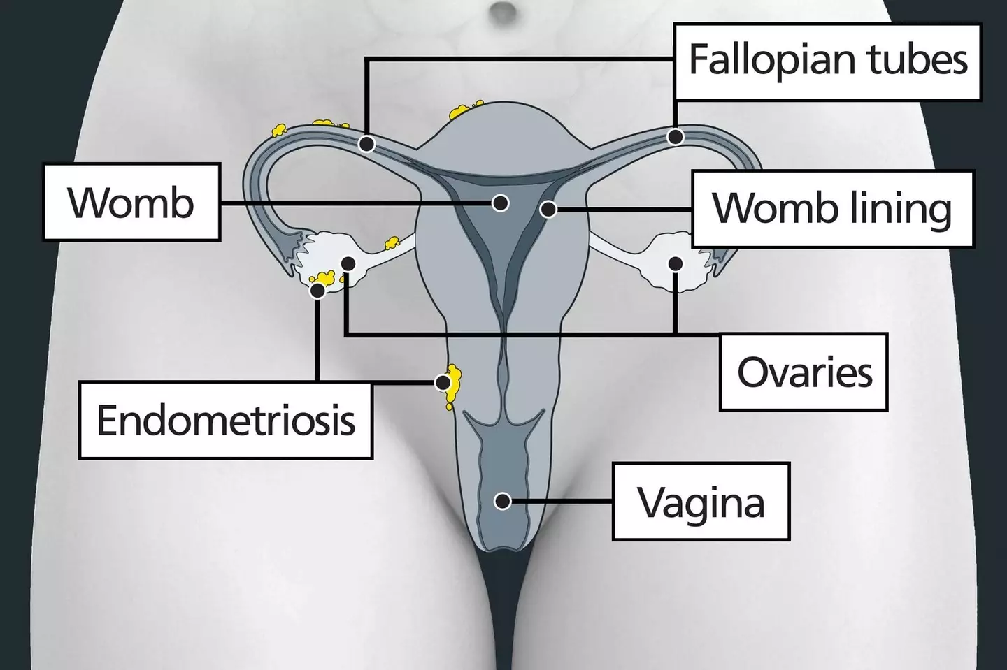 One in 10 UK-based women of reproductive age are estimated to suffer from endometriosis (NHS)