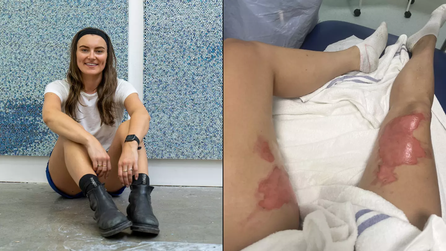 Woman issues major hot water bottle warning after being burned so badly she couldn’t use toilet