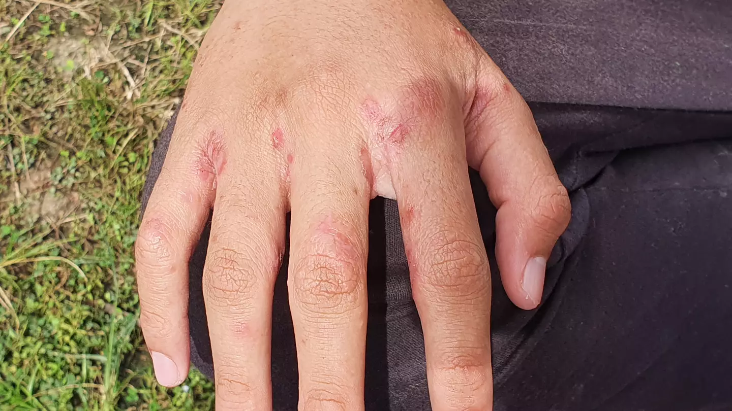 Doctors share concern about rise of Victorian disease in UK that comes with visible signs