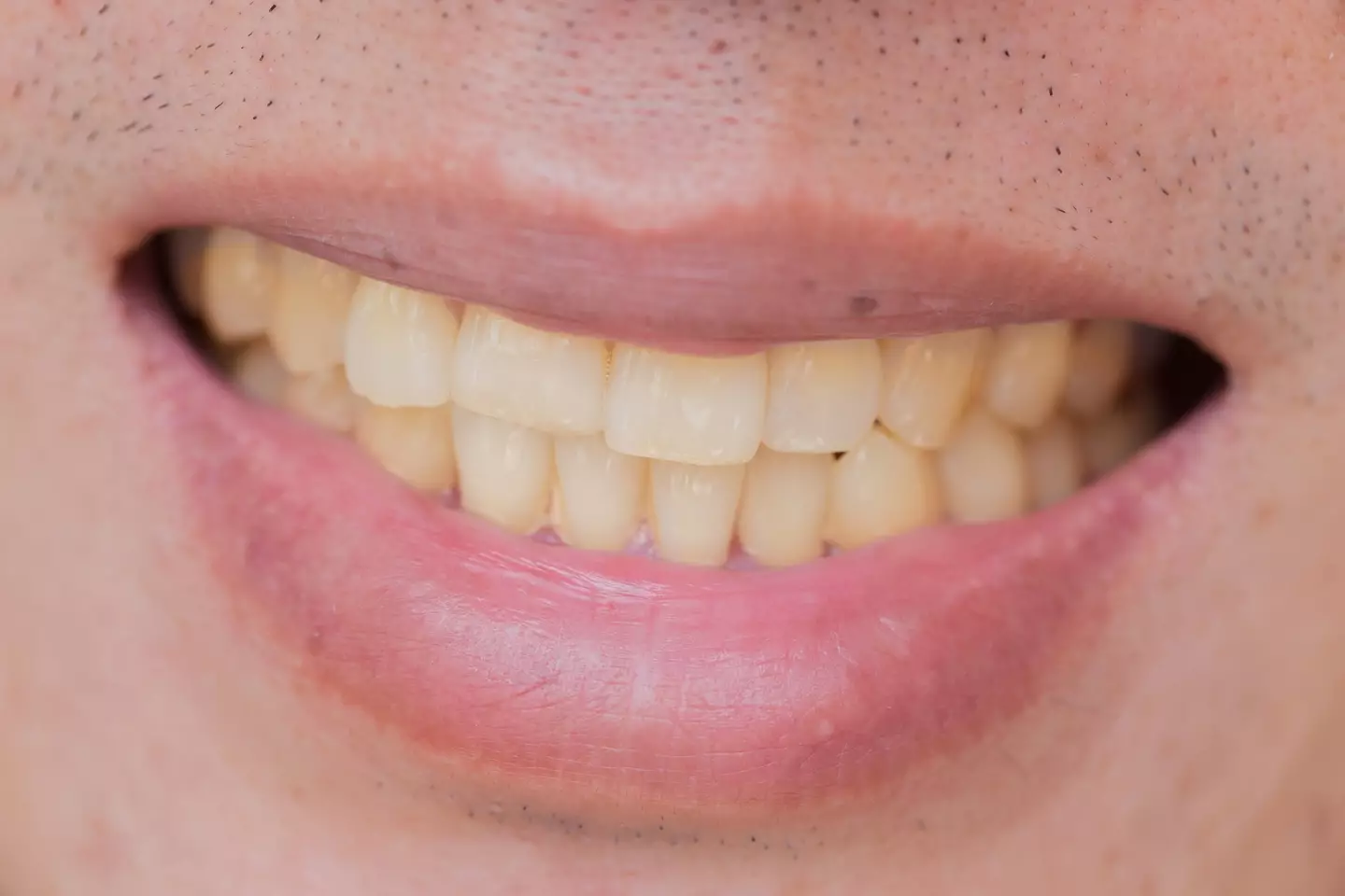 Banishing yellow stains is a very common dental concerns. (Getty Stock Images)