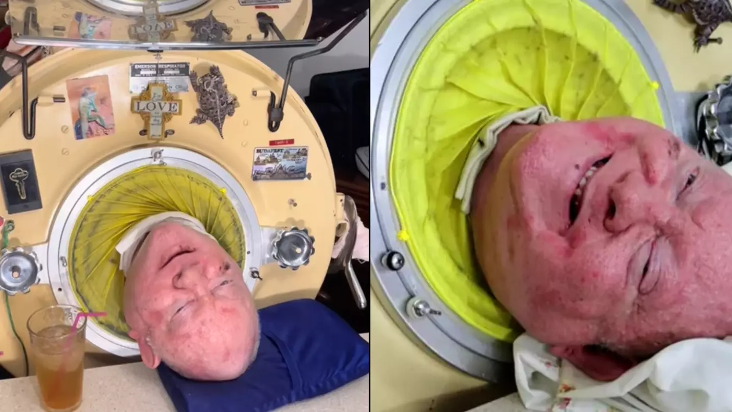 People left wondering if man who lives inside iron lung machine can actually get out