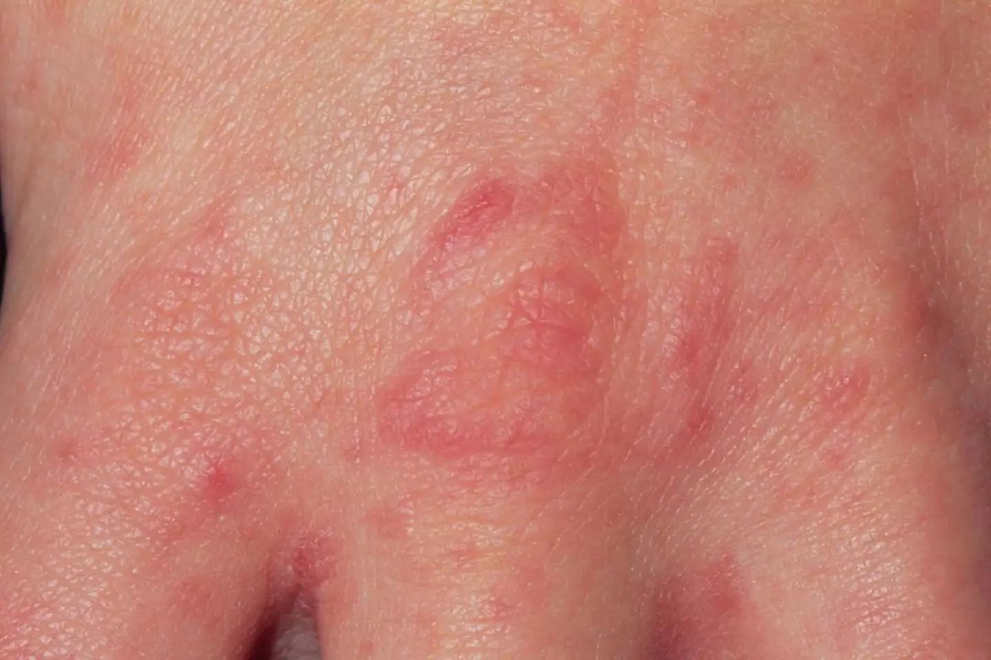 The rash can appear anywhere on the body.