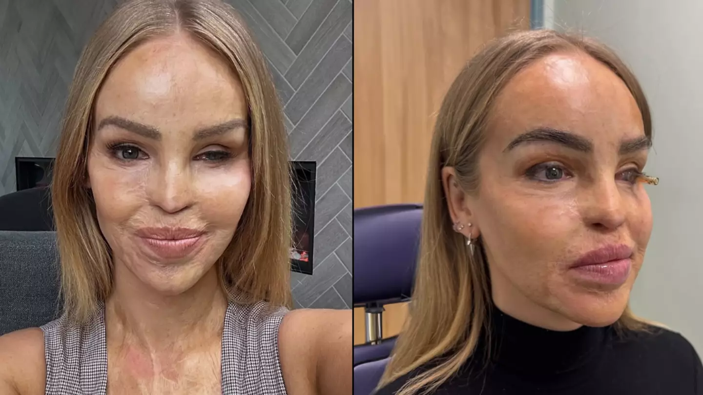 Katie Piper described horrifying life-changing acid attack that left her with severe injuries