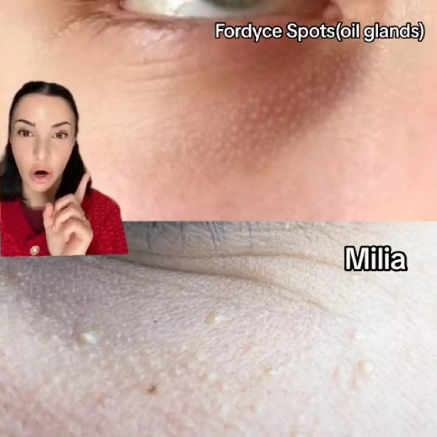 Fordyce spots are small, painless white bumps (TikTok/@cheboclinic)