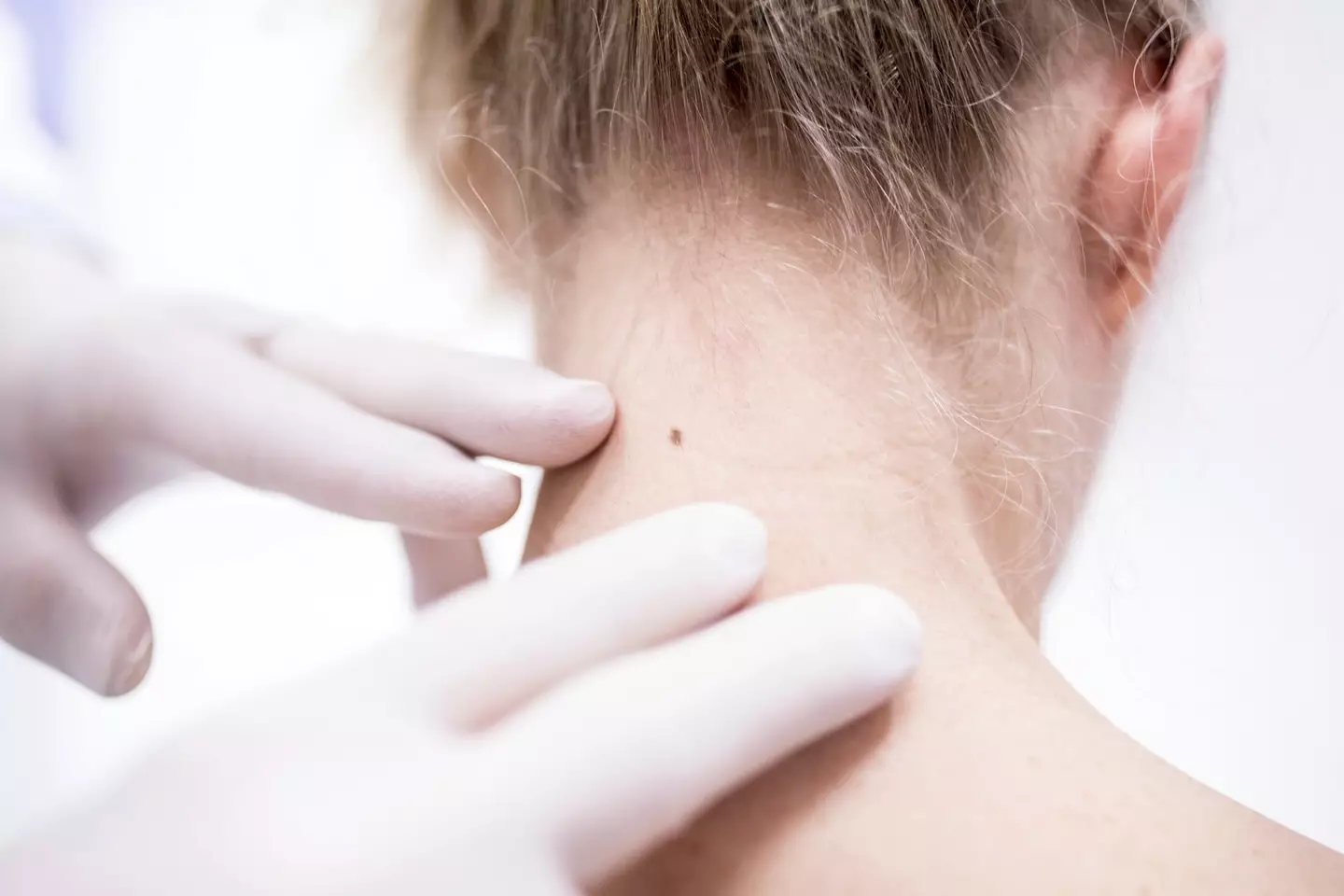 There could be lots of causes behind the marks we find on our skin and some need your attention. (Getty Stock Photo)