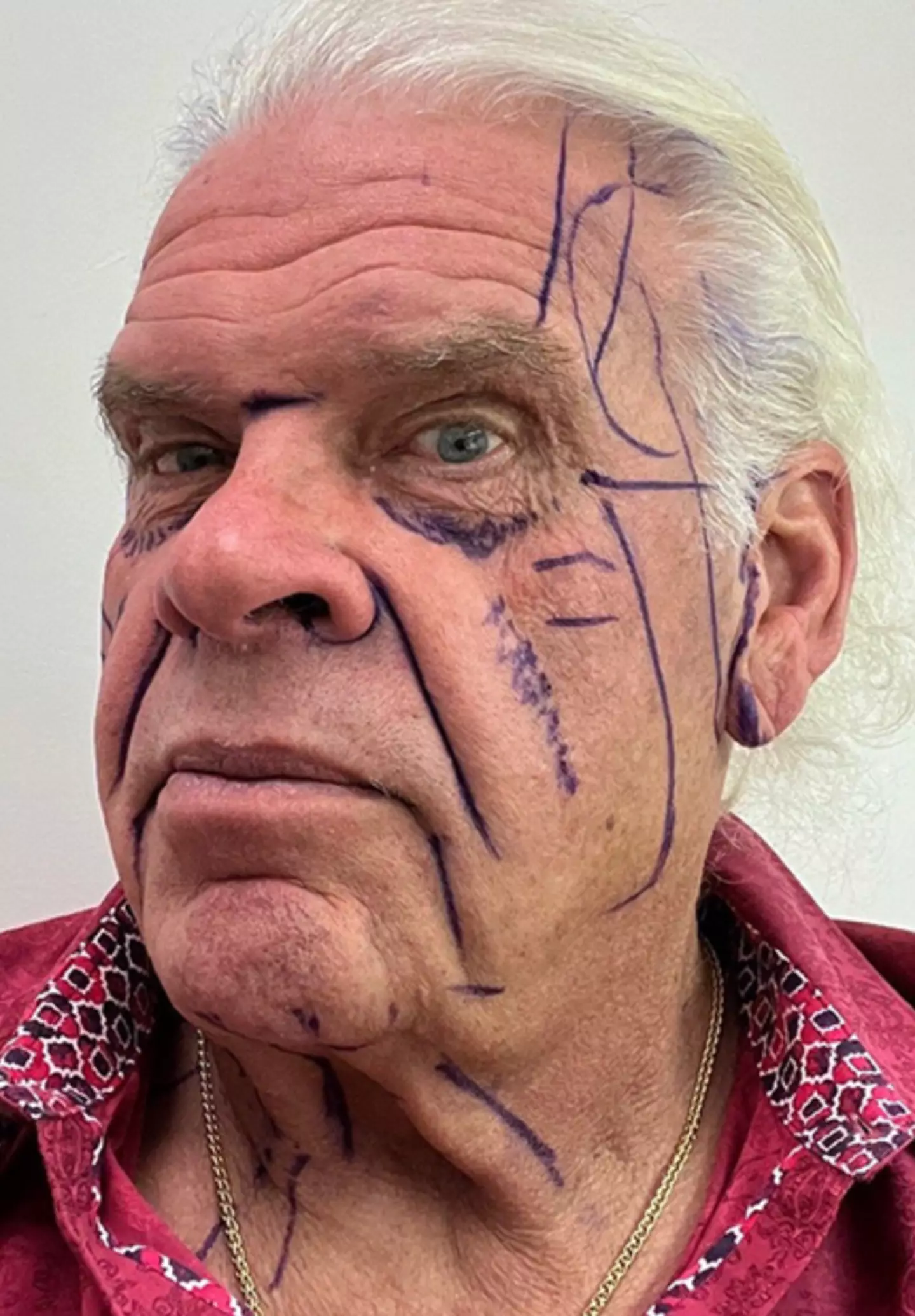 Here's a before photo of the bloke (Kassir Plastic Surgery)