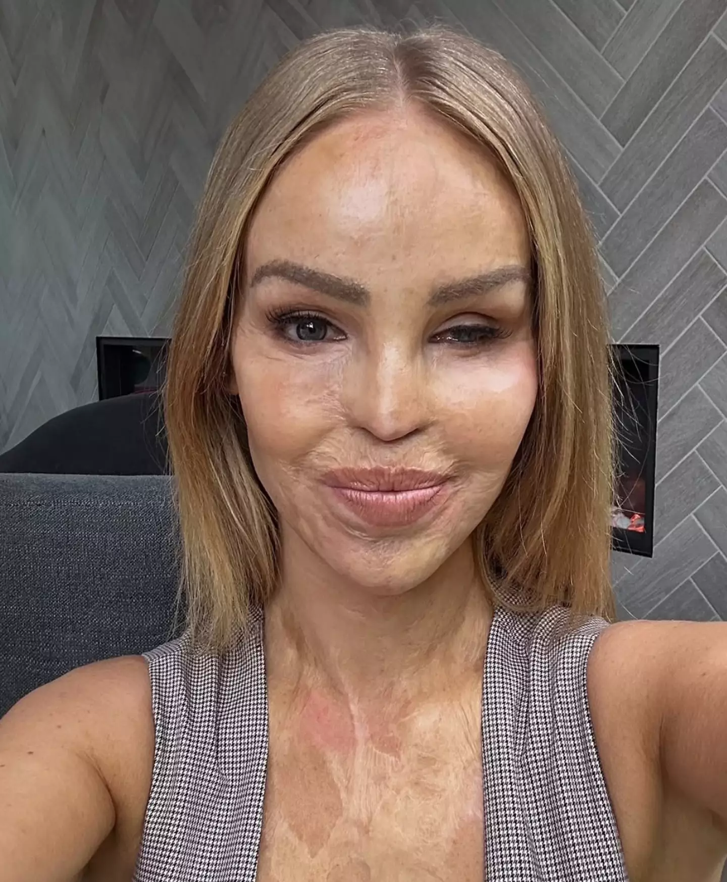 Katie Piper suffered life-changing injuries after an acid attack in 2008 (Instagram/@katiepiper_)