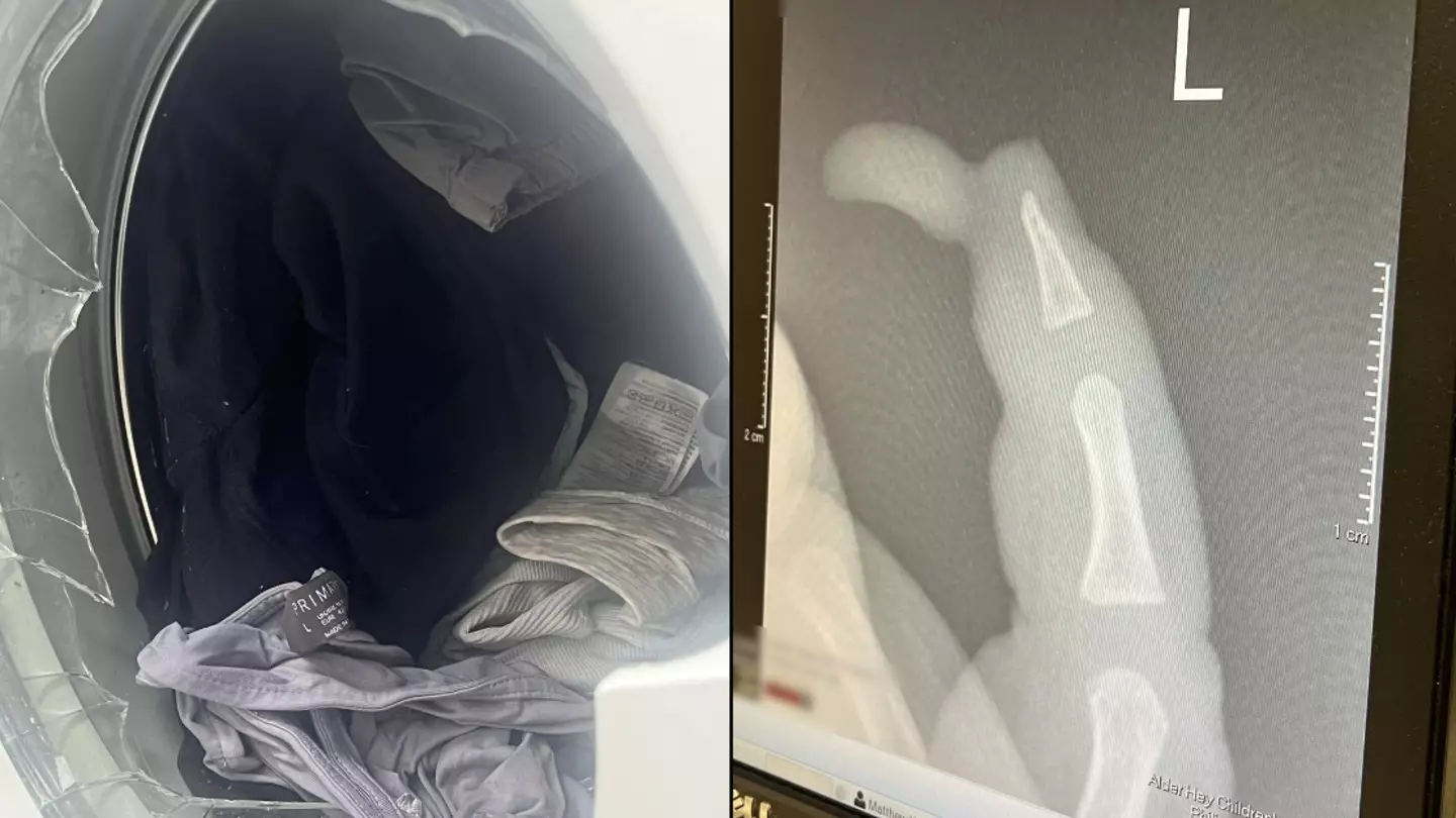 Mum claims toddler almost killed by exploding washing machine which left chunk of finger 'hanging off'