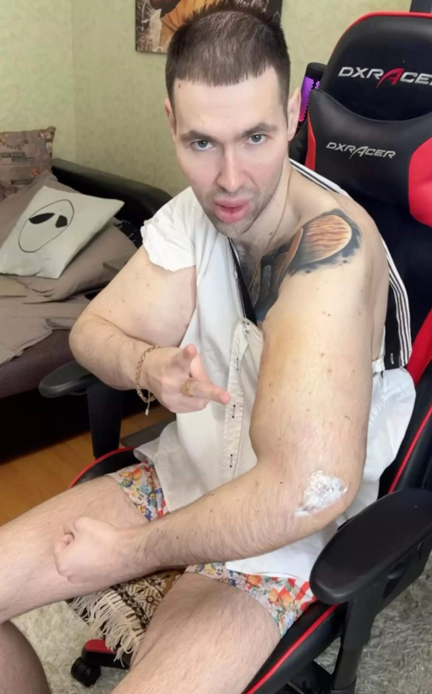 The Russian influencer revealed he has had 'surgery to remove the biceps' (Instagram/@ruki_bazuki_official)