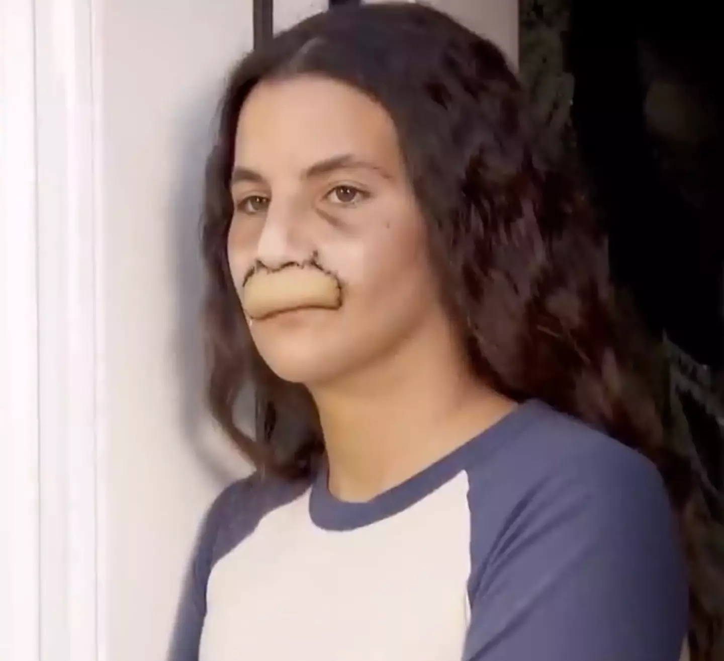 Brooklinn was attacked by her cousin's dog. (Inside Edition)