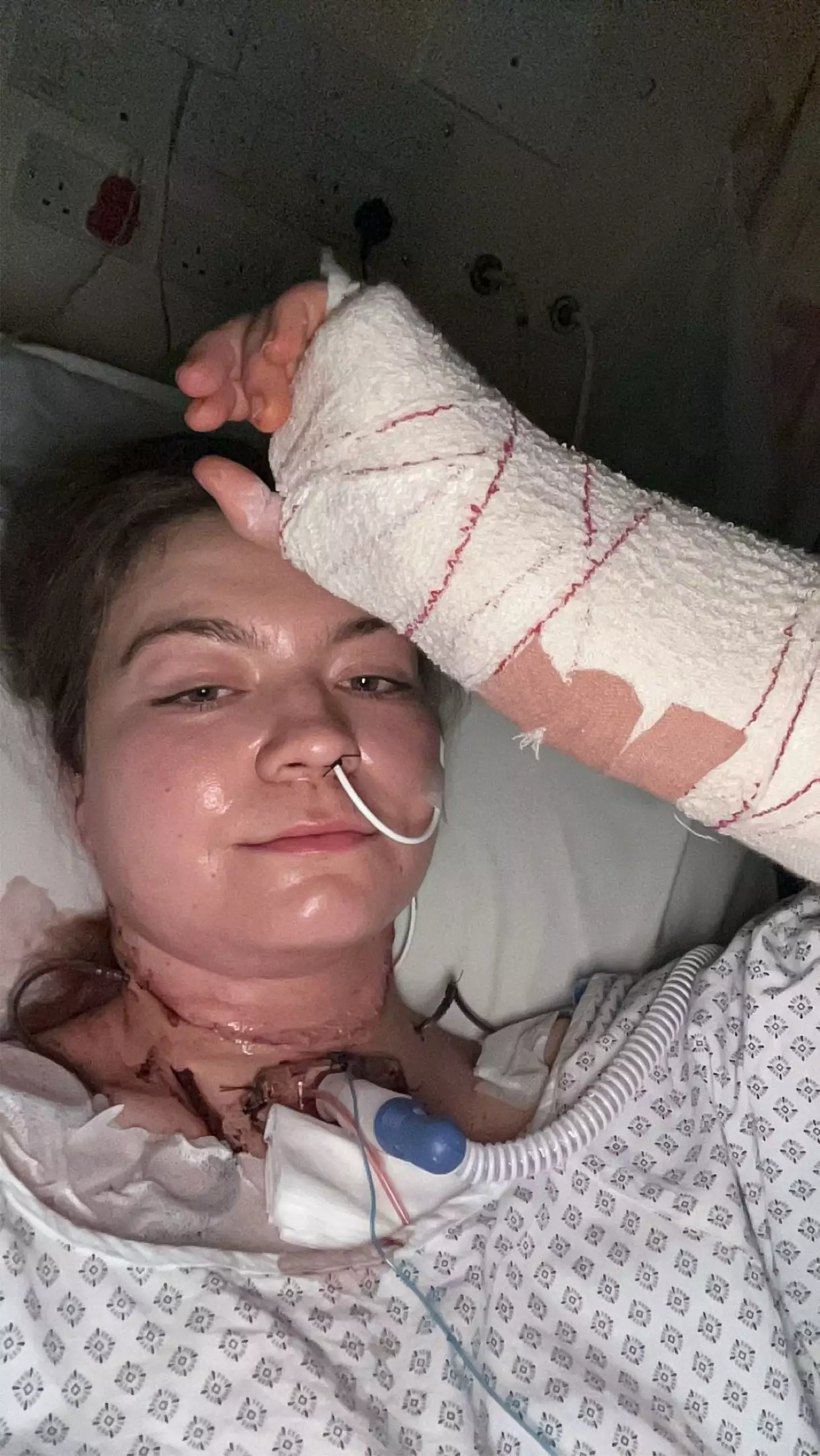 Skin was taken from her forearm to replace part of her tongue (Kennedy News and Media)