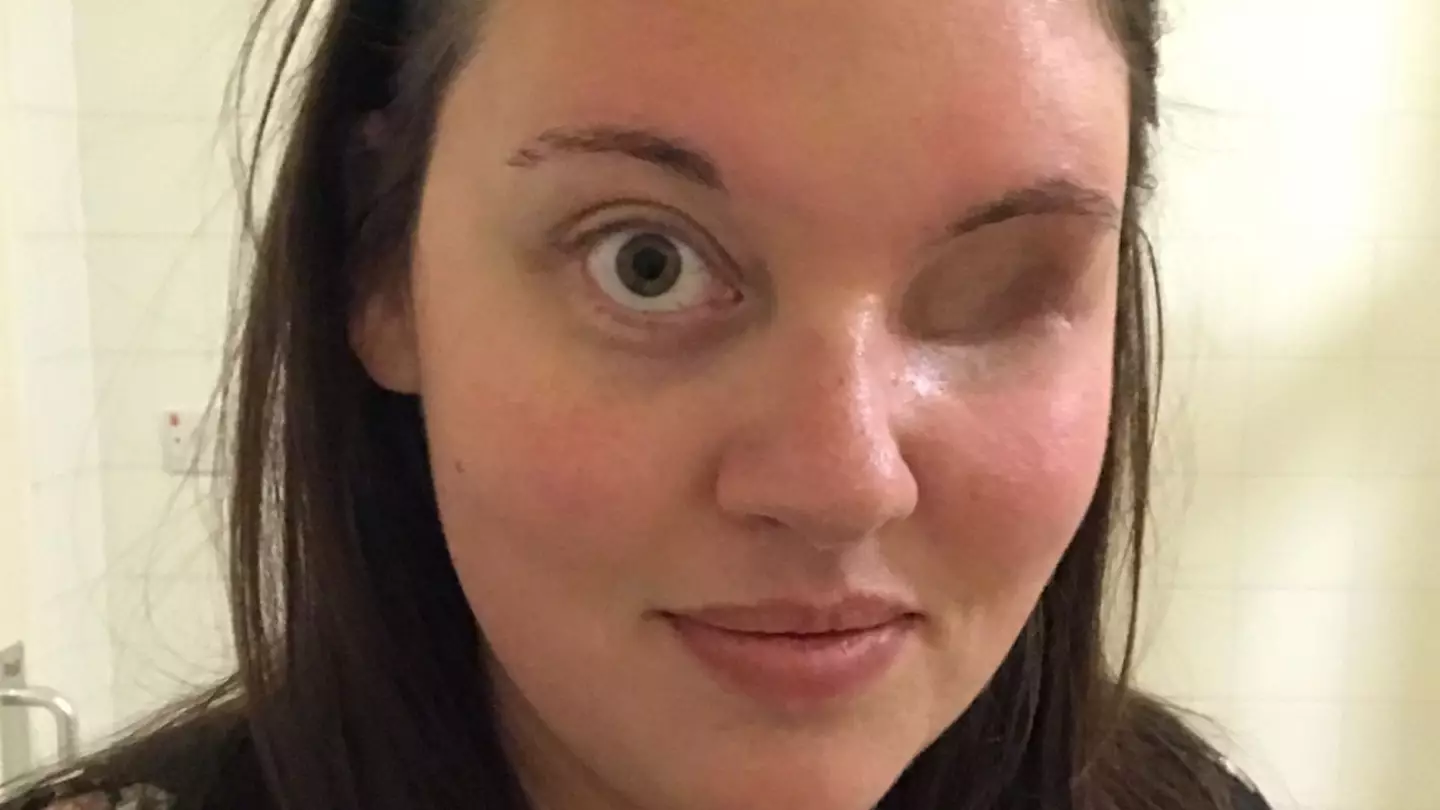 Mum With Rare Form Of Cancer Refuses To Wear A Prosthetic Eye
