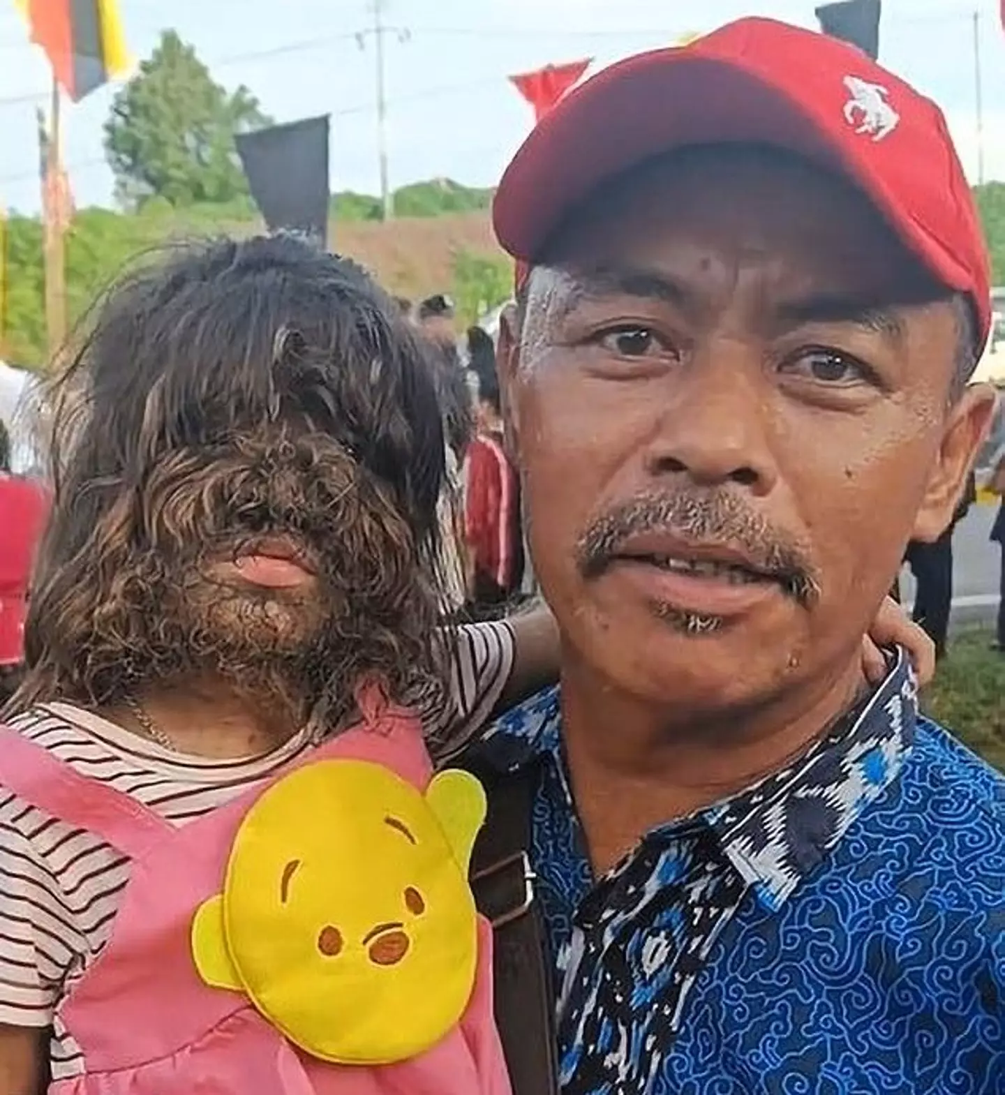 A two-year-old girl with 'werewolf syndrome' has been dubbed a 'child from heaven' by Malaysia's royals.