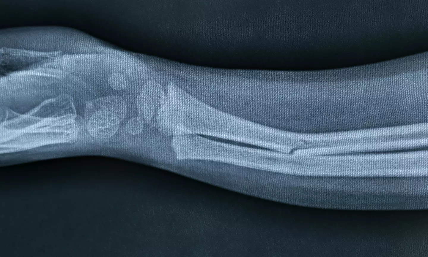 A broken bone is included in the NHS' list of the top 20 most painful human experiences.