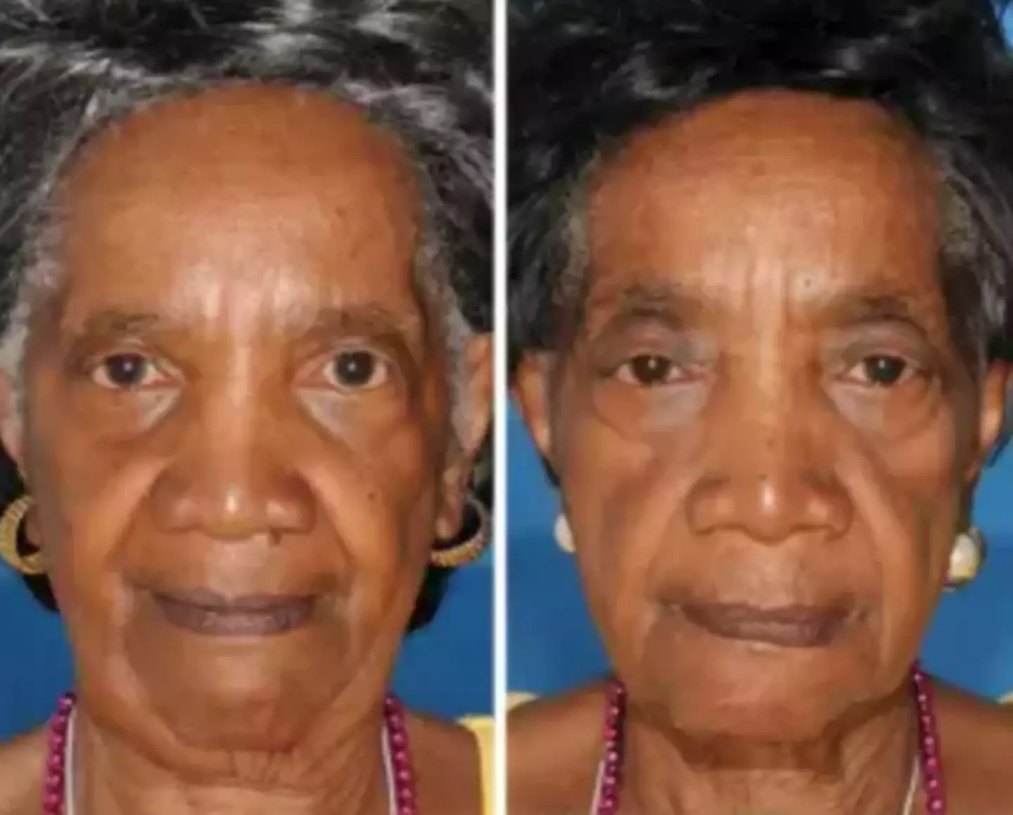 The twin on the left here is a non-smoker (American Society of Plastic Surgeons)