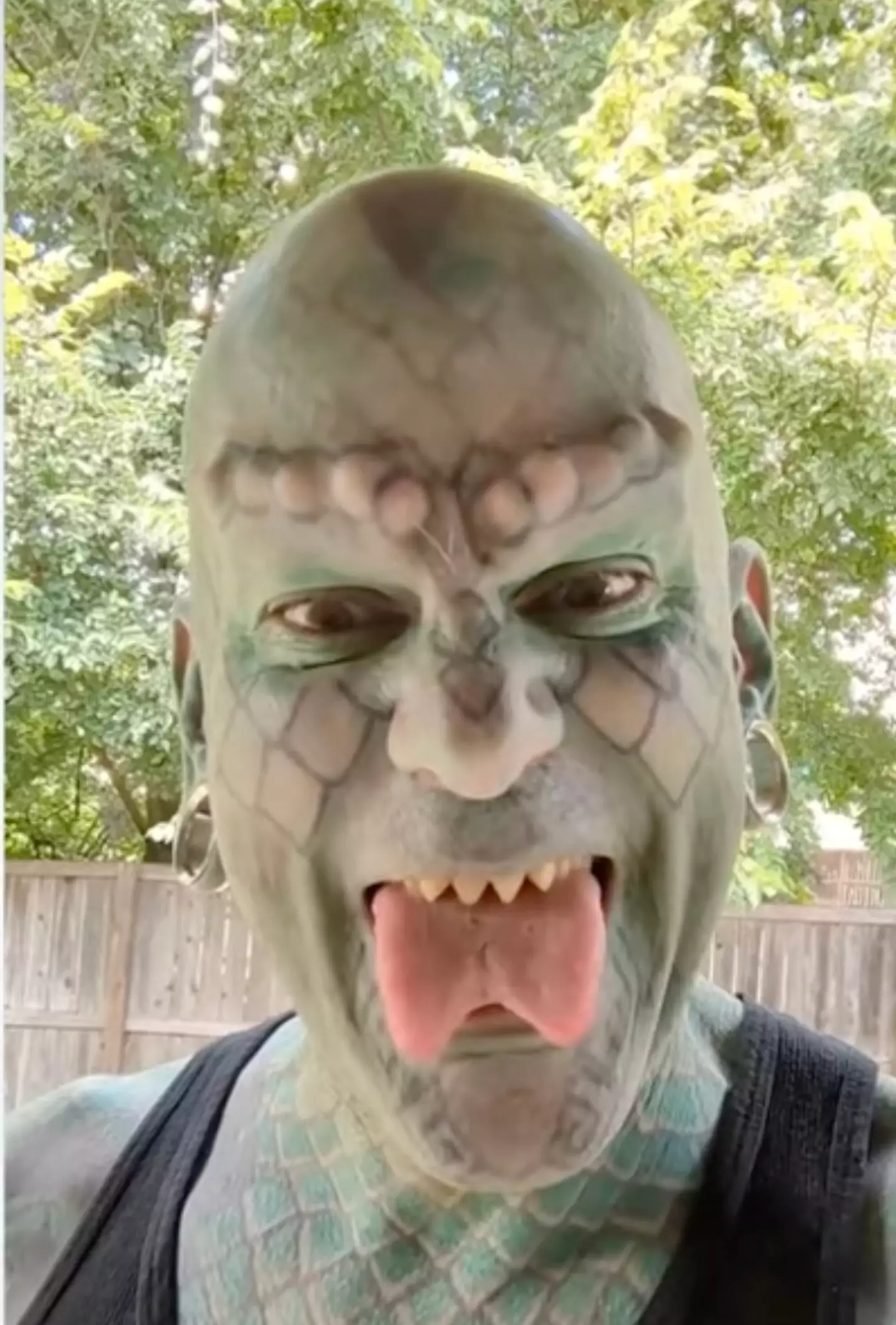 He was left vomiting and hallucinating after having implants put into his forehead. (ITV)