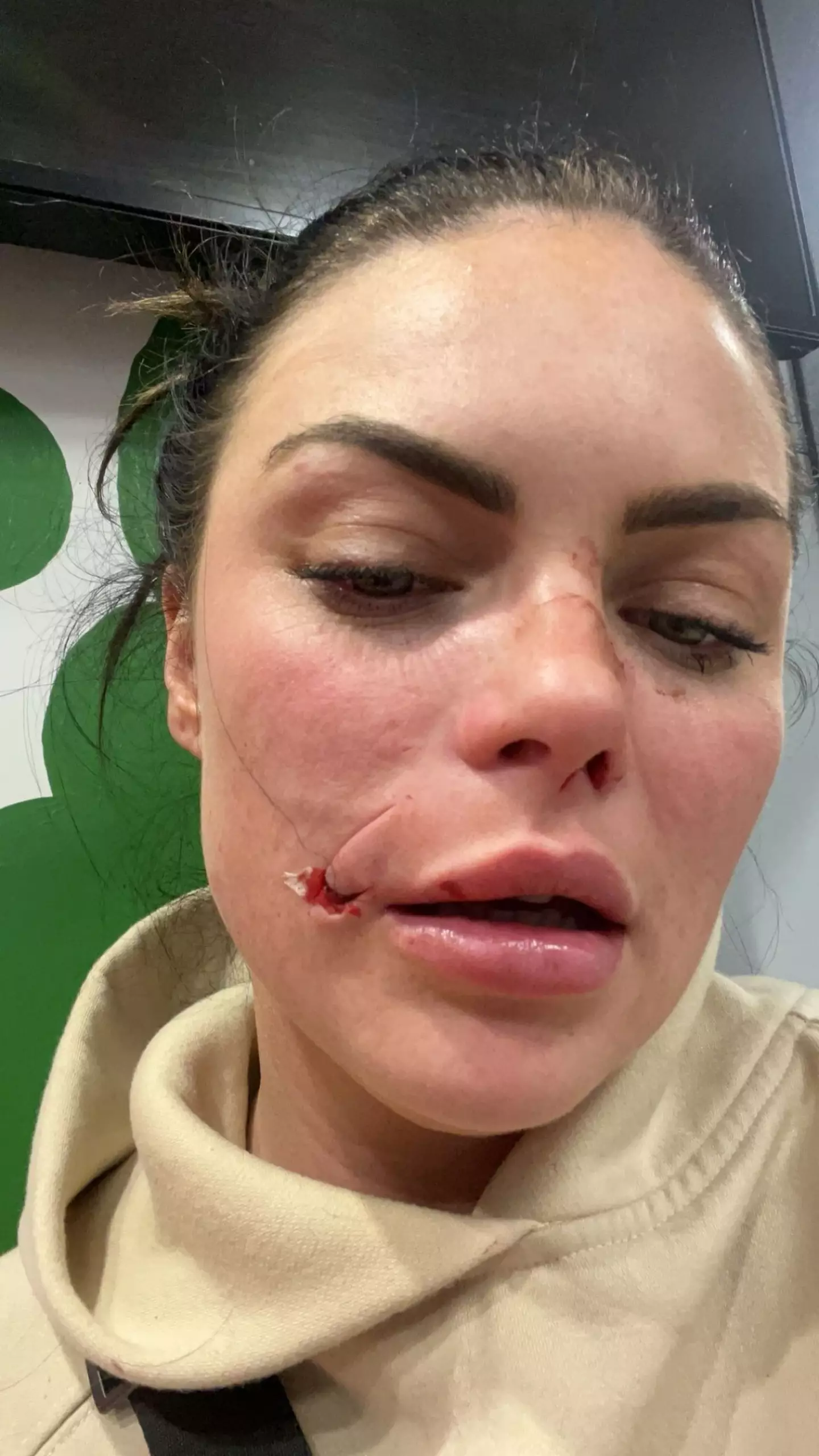Kelsea Morgan was attacked by her friend's dog.