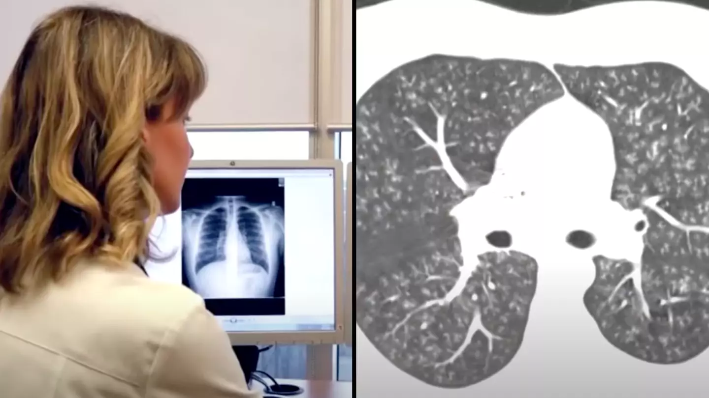 Doctor shows x-ray of 'popcorn lung' caused from vaping and it can be ...