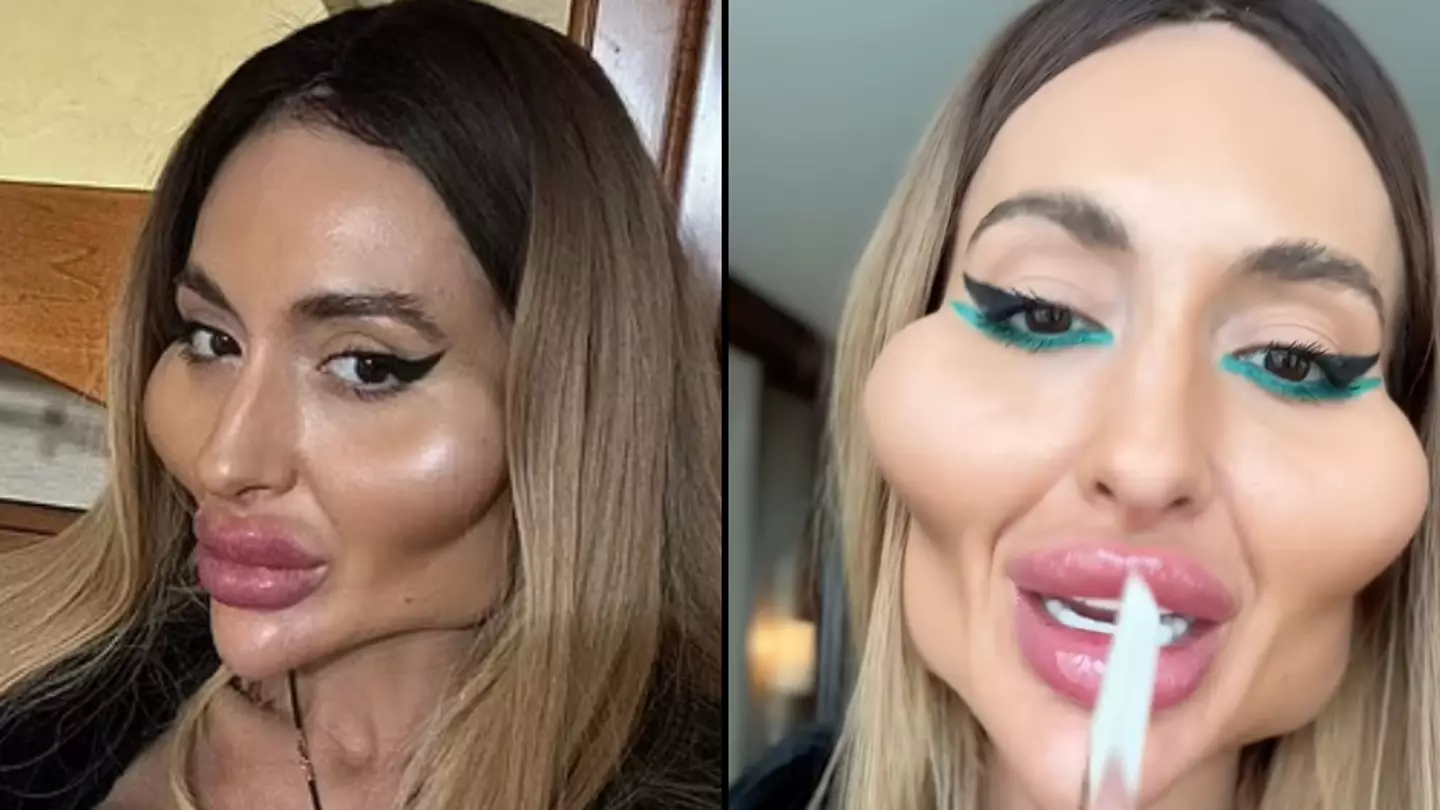 Model with 'world's biggest cheeks' shares image of what she looked like before £1,600 filler