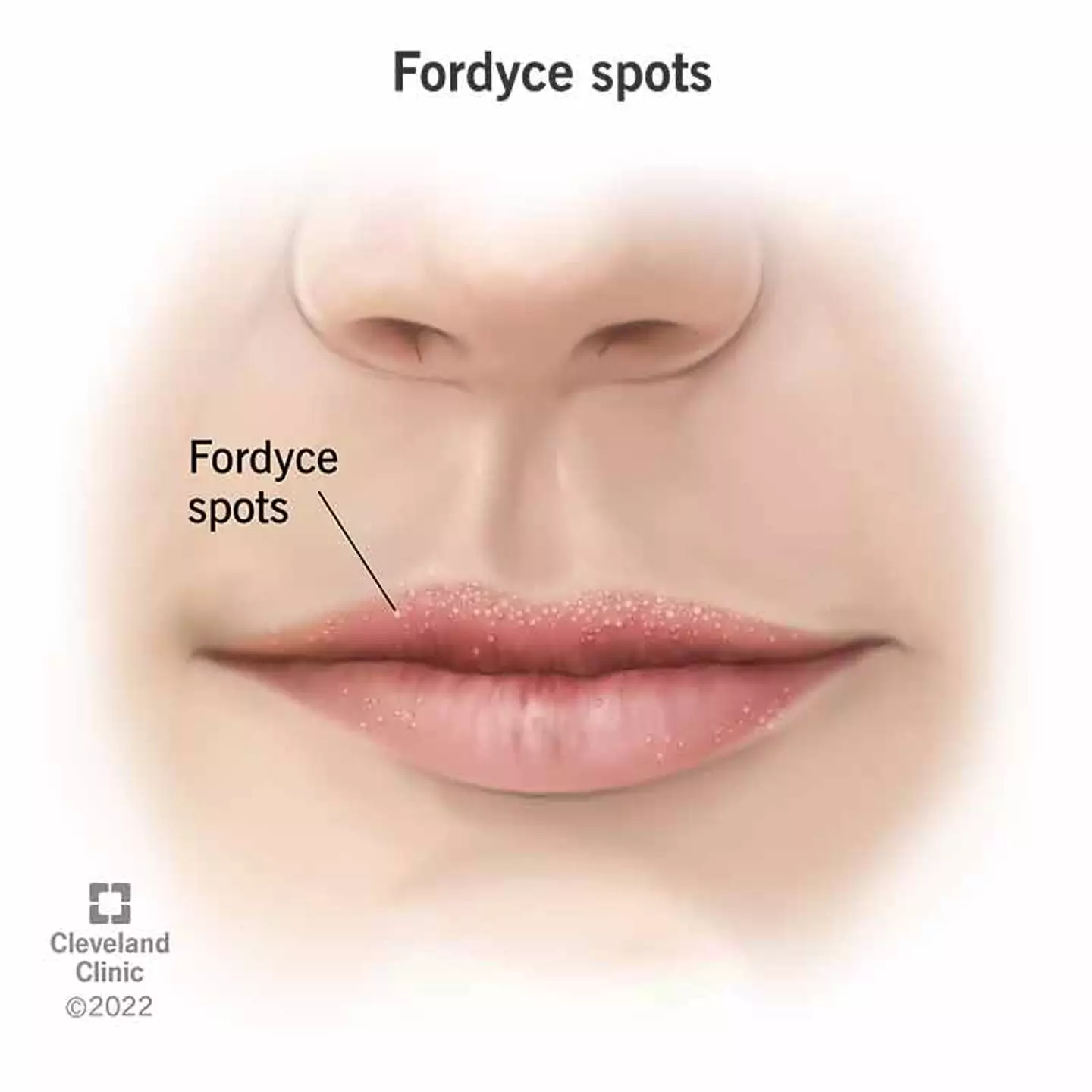 The lumps can also appear on lips.