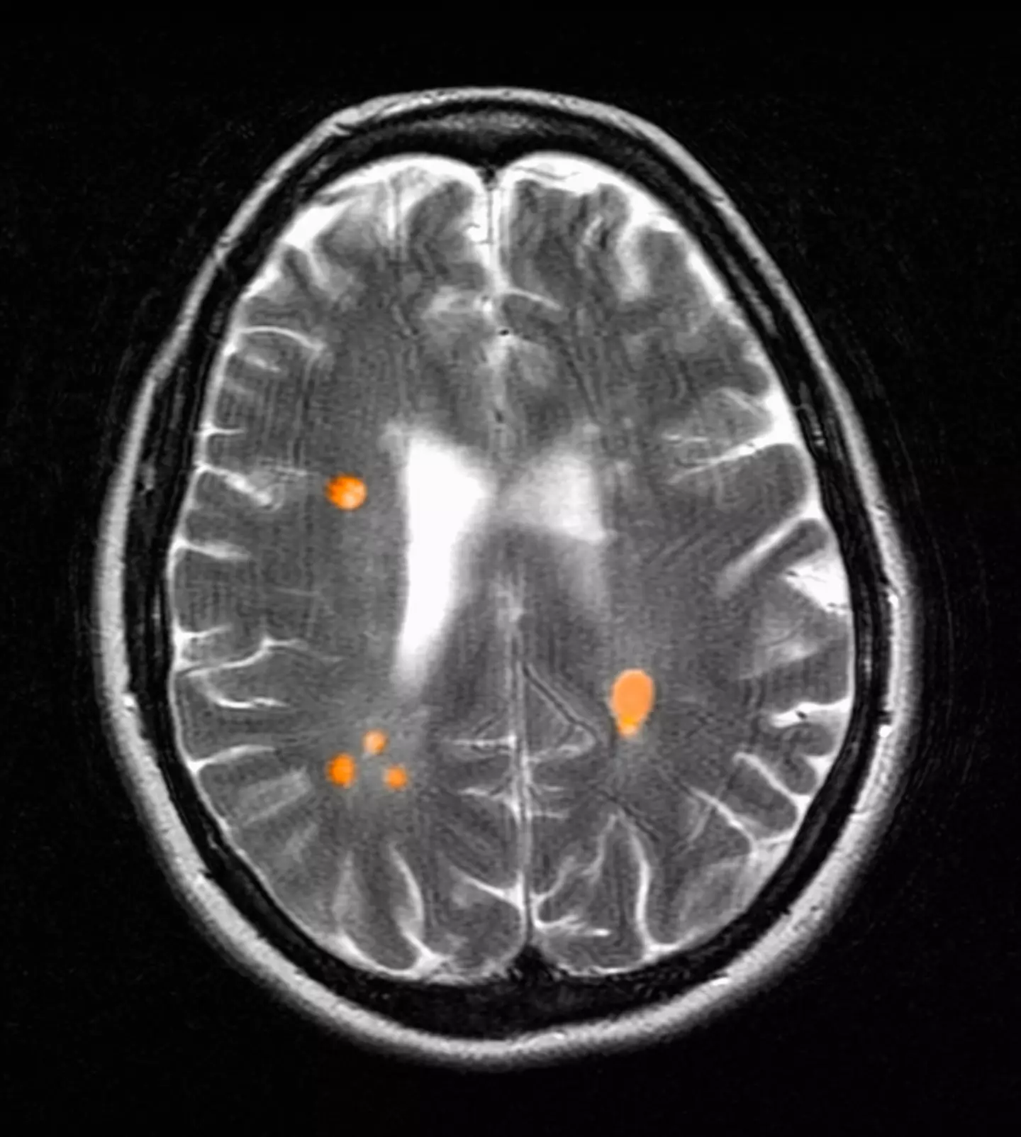 The NHS defines multiple sclerosis (MS) as 'a condition that can affect the brain and spinal cord, causing a wide range of potential symptoms, including problems with vision, arm or leg movement, sensation or balance'.