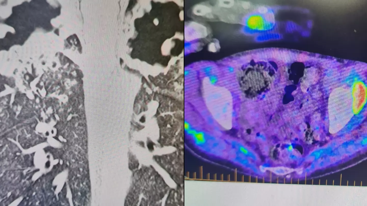 Man, 33, left 'slowly dying' with destroyed lungs after life-changing mistake at friend's house