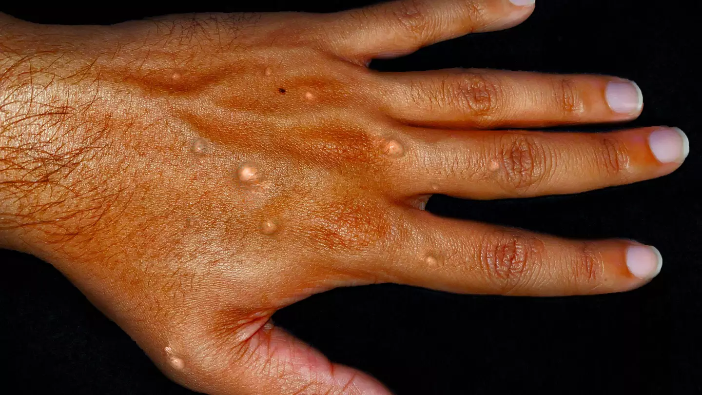 New South Wales records first local monkeypox case