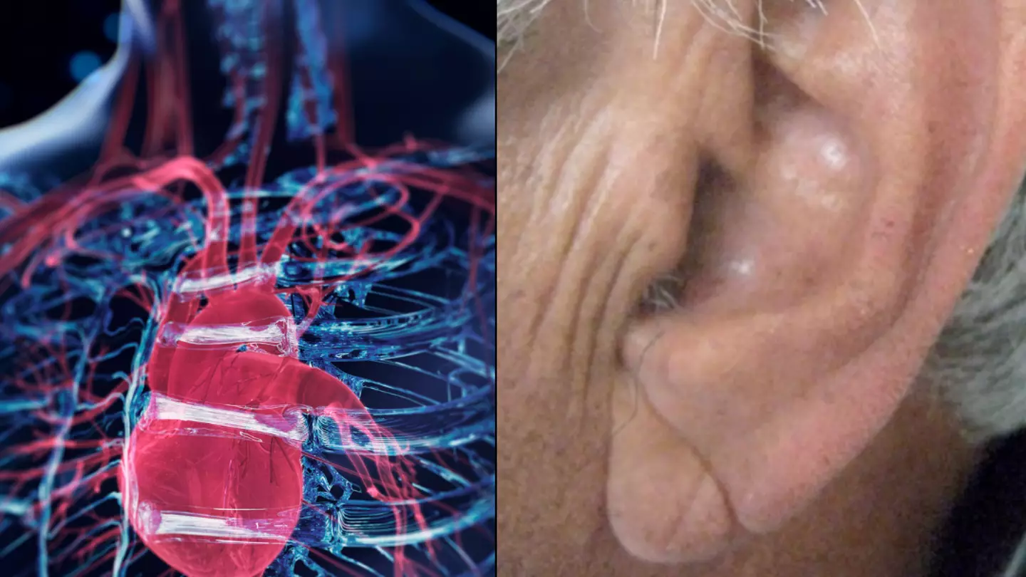 Some people have a distinct mark on their earlobe that can be a sign of poor heart health