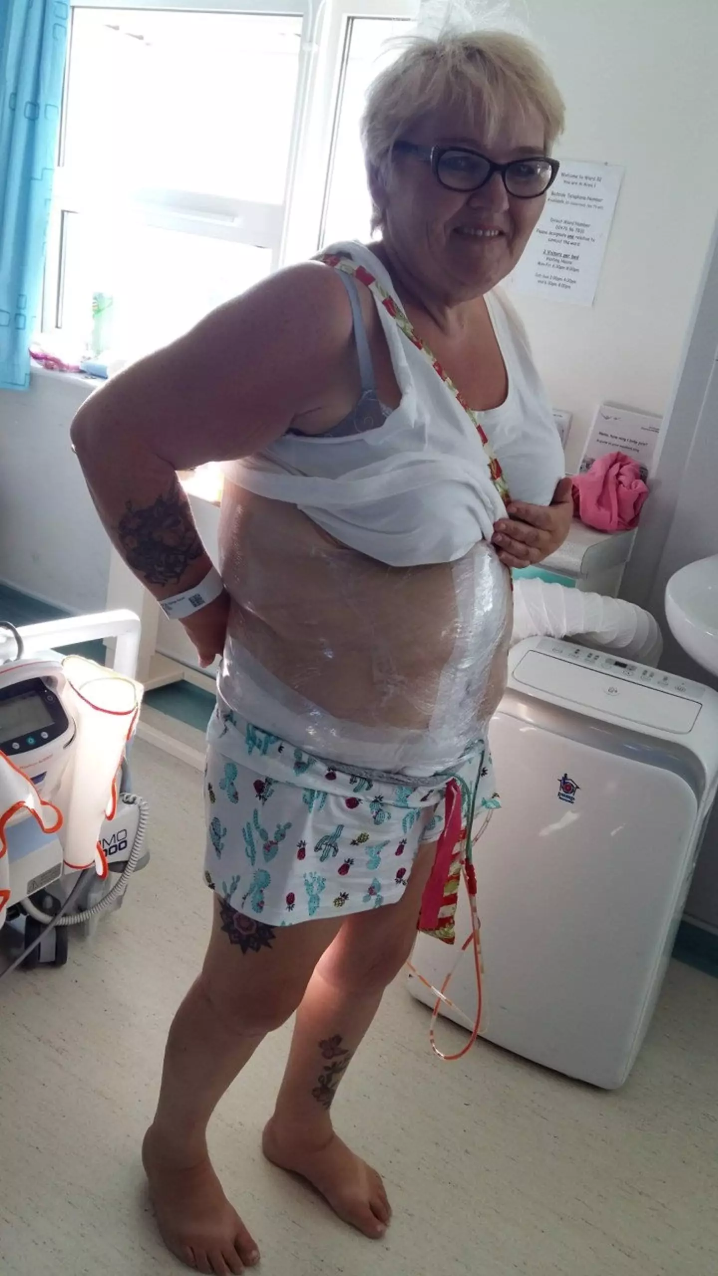 Hodgson has had two surgeries to get rid of 2st of excess skin after losing a lot of weight quickly.