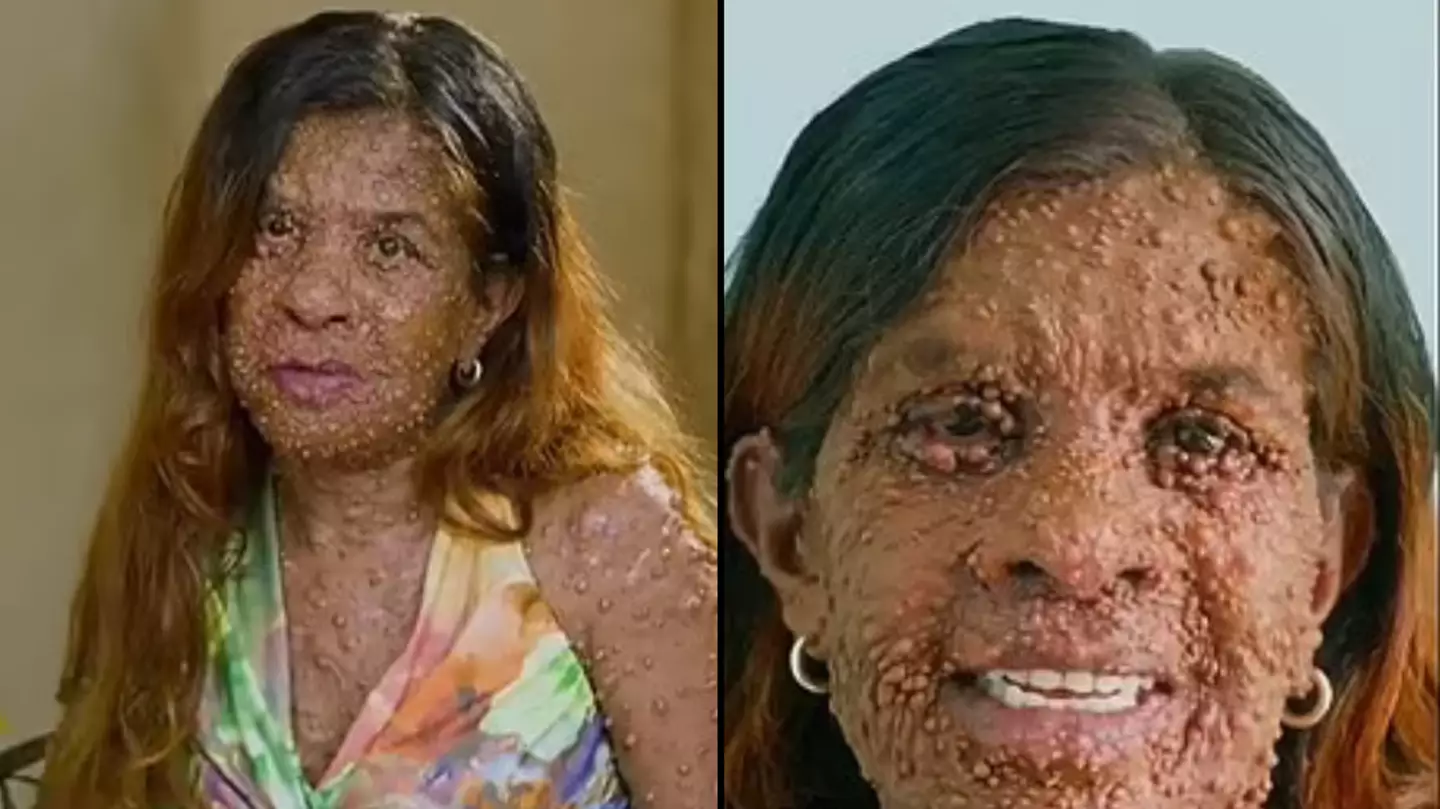 Woman has 'one-of-a-kind' disease that causes thousands of life-threatening tumours to grow all over body