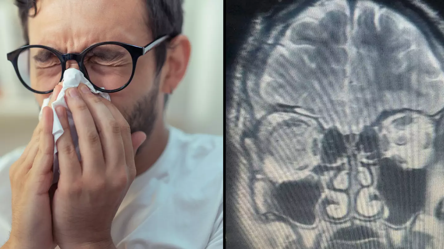 Man who thought he had a runny nose actually had his 'brain leaking'
