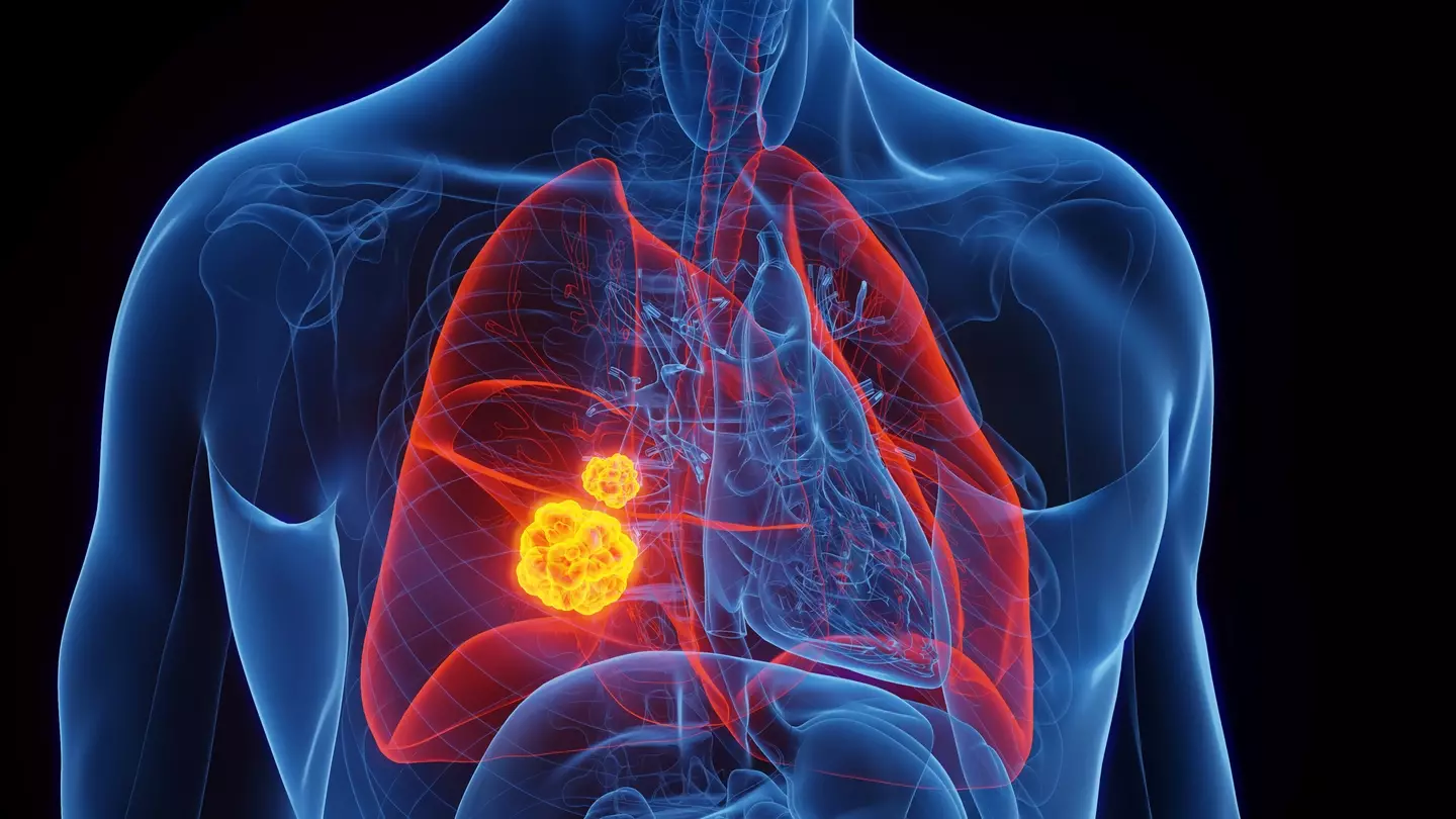 Lung cancer is one of the most common cancers globally (Getty Stock Images)