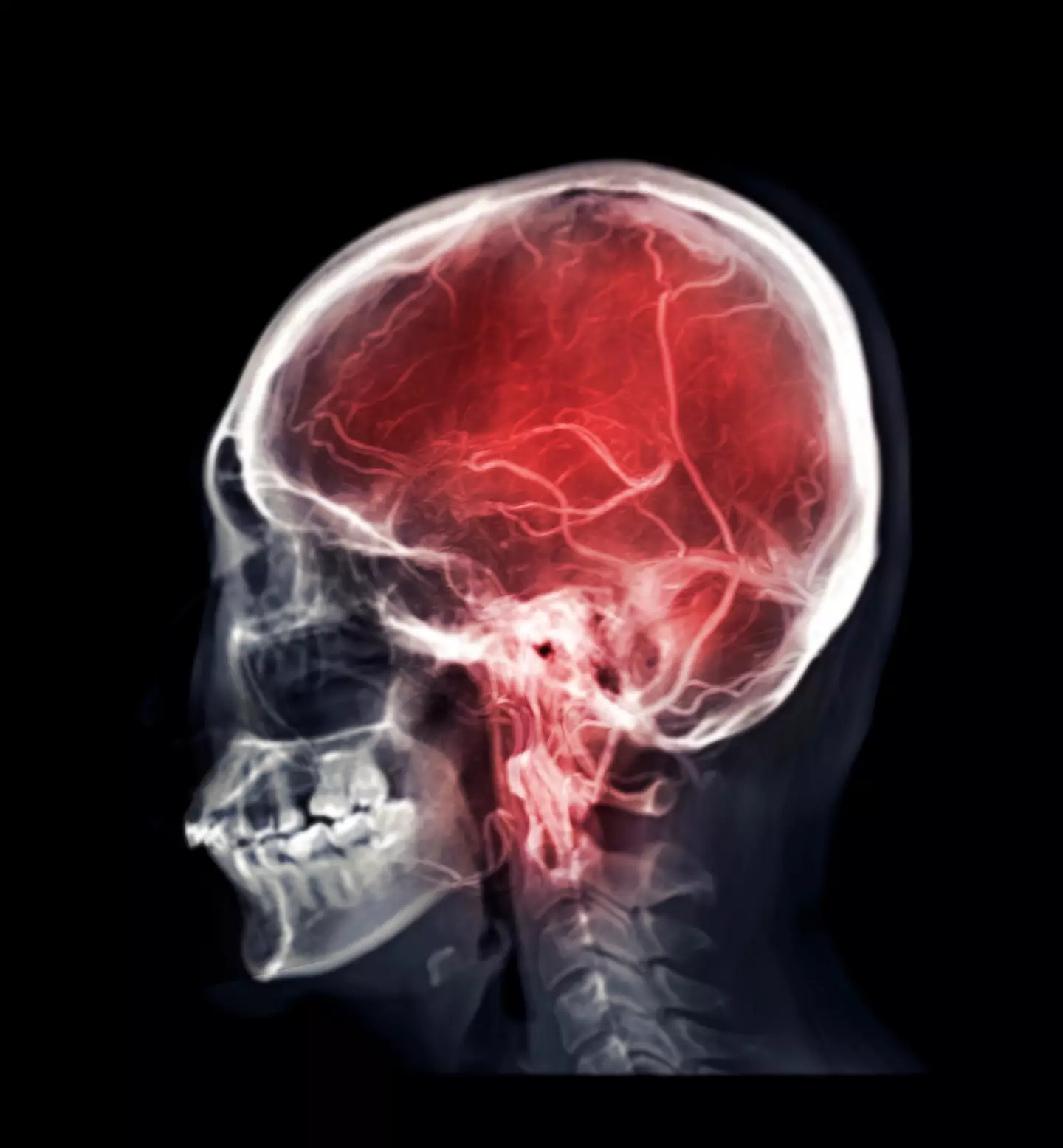 A burst brain aneurysm requires immediate medical attention (
