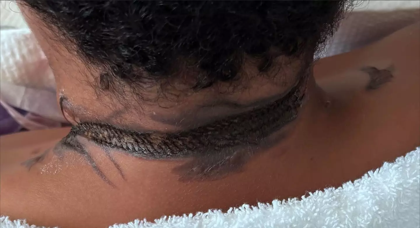 Ashtyn was left with serious burns on his neck (Kennedy News and Media)